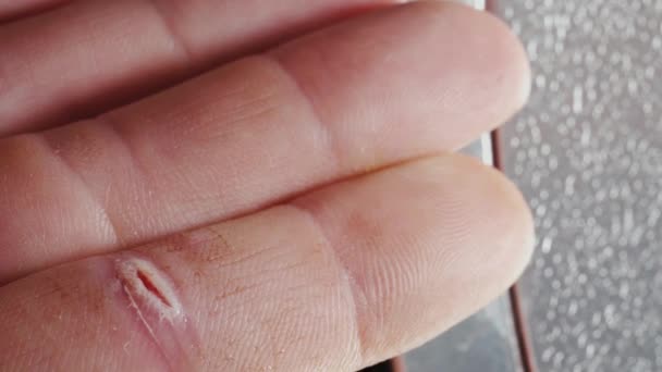 Treatment Wound Finger Hydrogen Peroxide Macro — Vídeos de Stock