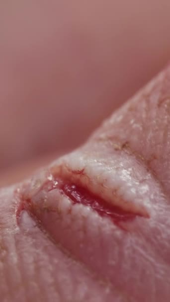 一个手指上的伤口 截断的垂直视频 — 图库视频影像