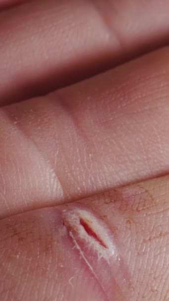 Tratamiento Herida Dedo Con Peróxido Hidrógeno Macro Vídeo Vertical — Vídeos de Stock