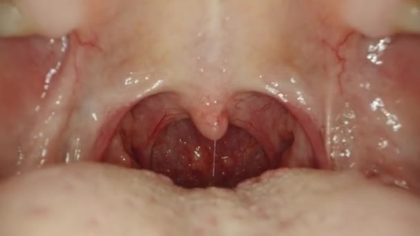 Irritated Reddened Throat Woman Illness Mouth Probe Goes Mouth Macro — Stock Video