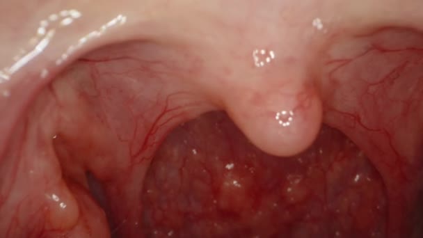 在女人的喉咙深处 探头从她的嘴里伸出来 生病时的红喉 — 图库视频影像