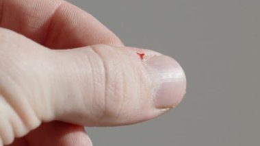 Yırtık Küpeştedeki Adamın Büyük Başparmağında Kan.