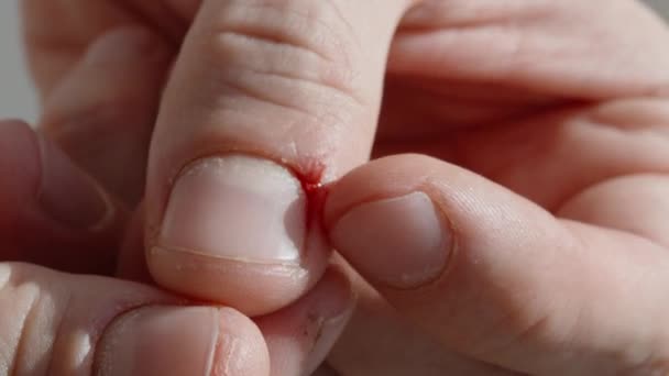 Hombre Rasgó Cutícula Dedo Sangre Comenzó Primer Plano — Vídeos de Stock