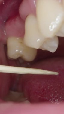 Dikey video. Bir adam, tahta kürdan kullanarak Uzak Diş 'ten yiyecek kalıntılarını çıkarmaya çalışıyor. Ağzın İçindeki Macro.