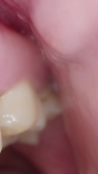 Dikey Video Yanağın Arkasındaki Ağız Içindeki Diş Görüntüsü Makro Diş — Stok video