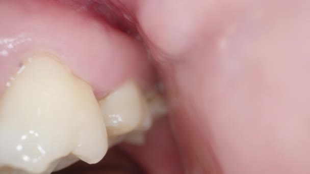 Vue Des Dents Intérieur Bouche Derrière Joue Examen Macro Dentaire — Video