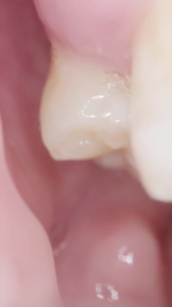 垂直录像 在口腔里面 从上面拔出的牙齿到一个空虚的空间 伤口已经痊愈了 — 图库视频影像