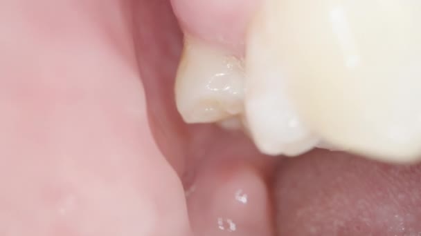 在口腔里面 从上面拔出的牙齿到一个空虚的空间 伤口已经痊愈了 — 图库视频影像
