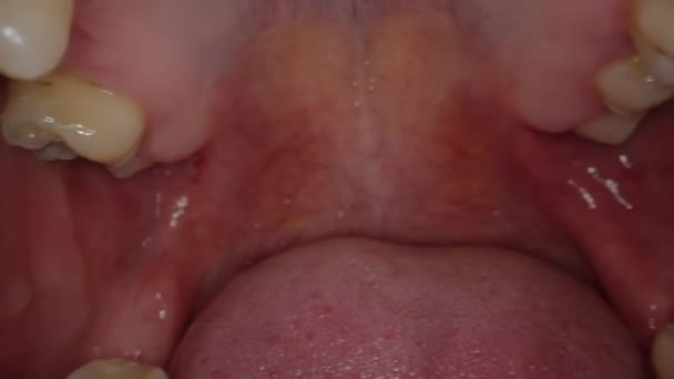 口腔内的摄像头显示牙齿向侧边 舌头向后压 大口径口腔卫生测试 — 图库视频影像