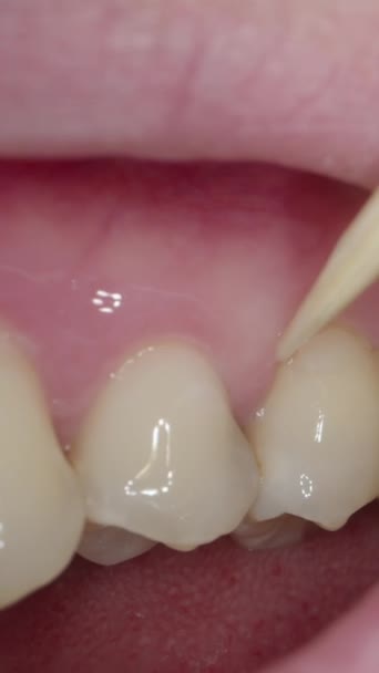 垂直录像 一个满嘴胡茬的男人用牙签在他的牙齿上挑刺 — 图库视频影像