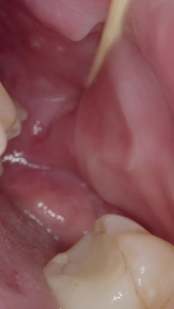 垂直录像 嘴巴里面 舌头在牙齿和牙齿之间滑行 试图找回什么东西 — 图库视频影像