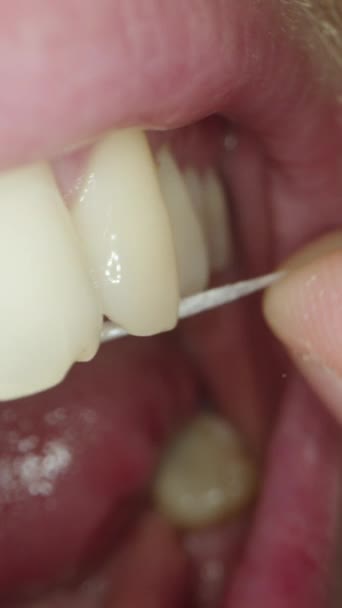 バーティカルビデオ 歯の損失との歯の間のギャップからの人間のクレンジングの食糧樹脂 マクロの遅い動き — ストック動画