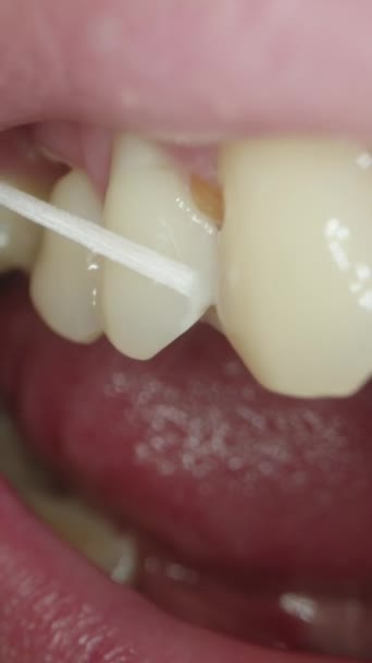 Vertikales Video Mit Zahnseide Zieht Der Mann Ein Stück Nahrung — Stockvideo