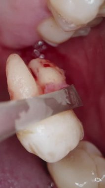 Vertical video. Extracted Tooth in Blood Is Pulled Out of Mouth, Macro.