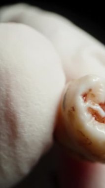 Dikey video. Beyaz Tıbbi Eldiven, Kanlı İnsan Dişini İnceledi. Yakın plan..