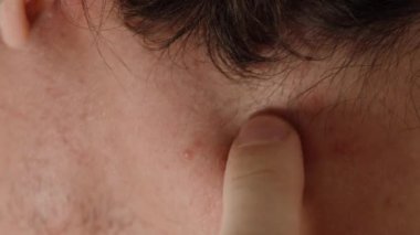 Boynunda sivilceleri toplayan sakallı bir adam. Yakın plan..