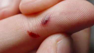 Parmak derisinin altında kan var, makro. Adam parmağını çimdikledi..
