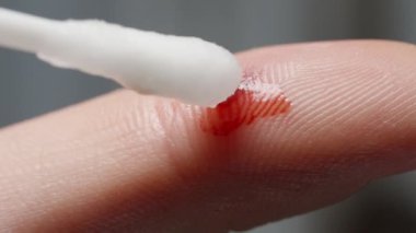Parmağındaki yarayı tedavi eden pamuklu bez. Hidrojen peroksitle ıslanmış kan köpürüyor. Makro.