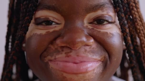 Närbild Glad Ung Kvinna Ansikte Med Vitiligo Ler Mot Kameran — Stockvideo