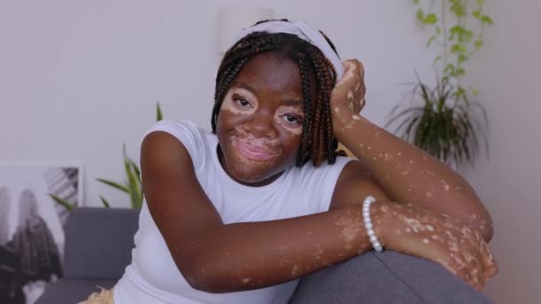 Portretul Unei Tinere Vesele Zâmbitoare Vitiligo Privind Camera Relaxare Canapea — Videoclip de stoc