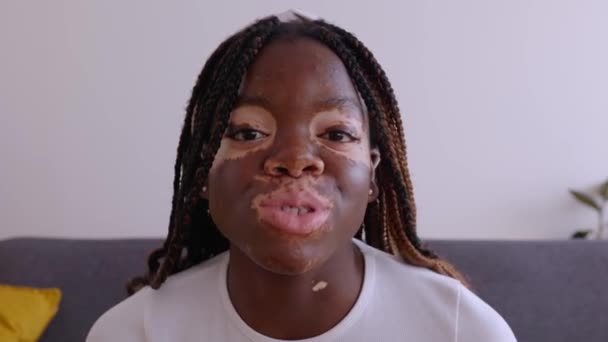 Pov Oder Portrait Ansicht Der Jungen Glücklichen Frau Mit Vitiligo — Stockvideo
