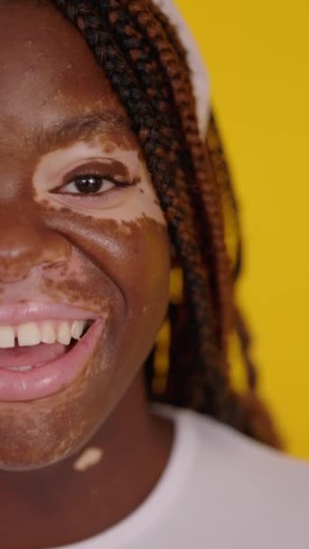 Крупным Планом Портрет Молодой Африканской Женщины Половину Лица Витилиго Косы — стоковое видео