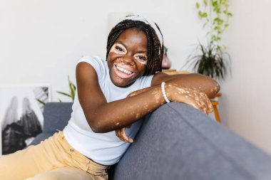 Vitiligo 'su olan neşeli, genç bir Afrikalı kadın evdeki kanepede dinlenirken kameraya gülümsüyor. Çeşitlilik, gençlik ve insan konsepti.