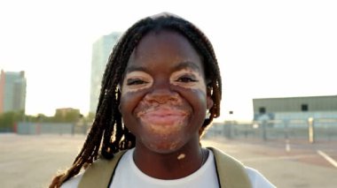 Vitiligo 'su olan genç siyahi kadın günbatımı arka planında kameraya gülümsüyor. Dışarıdaki binlerce yıllık neşeli Afrikalı kadının kendinden emin portresi. Çeşitlilik ve insanlar kavramı.