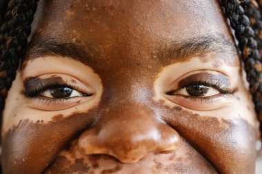 Vitiligo derili genç Afrikalı kadın gözlerinin yakın plan görüntüsü. Çeşitlilik ve insanlar kavramı