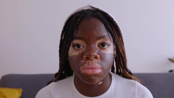 Крупним Планом Портрет Молодої Дорослої Серйозної Жінки Вітіліго Дивиться Камеру — стокове відео