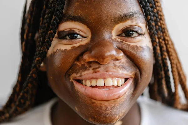 Nahaufnahme Einer Jungen Frau Mit Vitiligo Die Die Kamera Schaut lizenzfreie Stockfotos