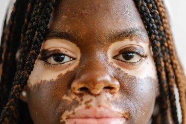 Kameraya bakan Vitiligo 'lu genç bir kadının yakın görüntüsü. Çeşitlilik ve insanlar kavramı