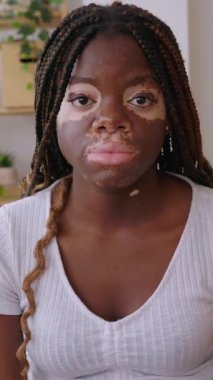Yatağında vitiligo taşıyan gülümseyen genç bir kadının mutlu portresi. Mutluluk ve pozitif insanlar