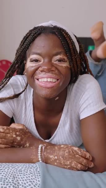 Retrato Sonriente Una Joven Adolescente Con Vitiligo Relajándose Dormitorio Acostado — Vídeos de Stock