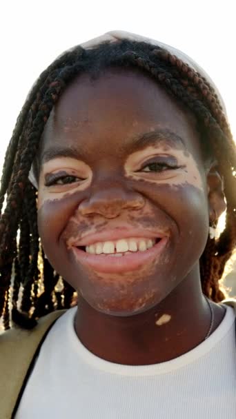Glad Ung Kvinna Med Vitiligo Ler Mot Kameran Utomhus Självsäkra — Stockvideo