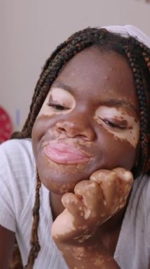 Dikey video. Vitiligo günüyle gülümseyen Afrikalı genç bir kadın yatakta yatarken hayal kuruyor. Düşünceli bin yıllık kadın odasında dinleniyor.. 