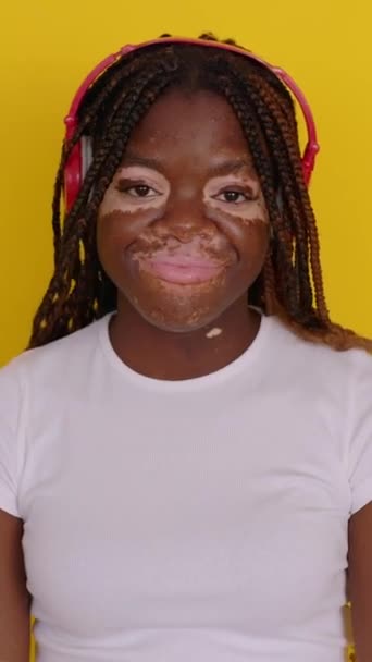 Porträtt Ung Tonåring Afrikanska Flicka Med Vitiligo Tittar Kameran Känsla — Stockvideo