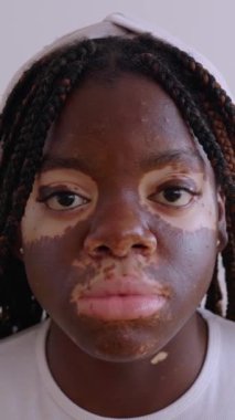 Vitiligo 'su olan ve kameraya bakan yetişkin ciddi bir kadının yakın plan portresi. Gençlik, çeşitlilik ve insanların konsepti.