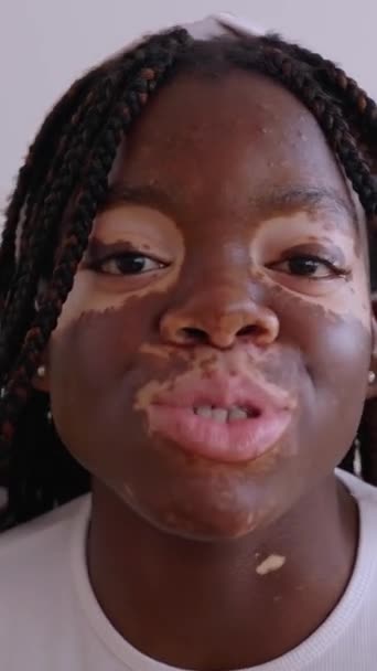 Pov Eller Porträttskärm Bild Ung Lycklig Kvinna Med Vitiligo Talar — Stockvideo