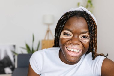 Vitiligo 'lu genç Afrikalı kadın portresi. Evdeki kanepede dinlenirken kameraya gülümsüyor.