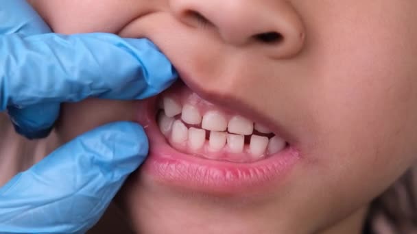 在一个健康的孩子的嘴巴里 有一排漂亮的乳牙 口腔和牙齿保健概念 — 图库视频影像