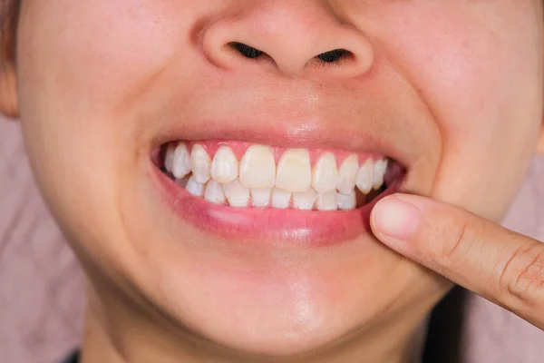 Close up of mouth of happy Asian woman touching the corners of her mouth with index finger while smiling broadly revealing her beautiful white teeth isolated on pink background.
