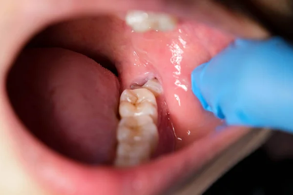 知恵の歯は影響を与え ガムの不況を引き起こす — ストック写真