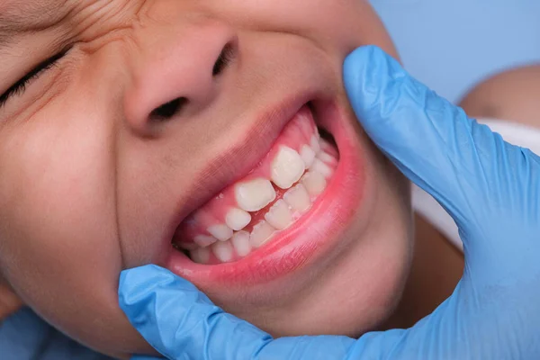 stock image Close-up inside the oral cavity of a healthy child with beautiful rows of baby teeth. Young girl opens mouth revealing upper and lower teeth, hard palate, soft palate, dental and oral health checkup.