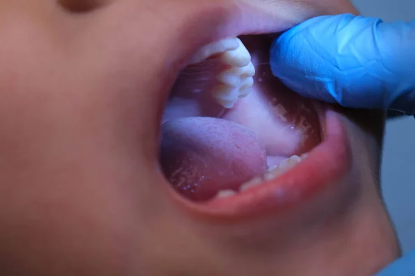 stock image Close-up inside the oral cavity of a healthy child with beautiful rows of baby teeth. Young girl opens mouth revealing upper and lower teeth, hard palate, soft palate, dental and oral health checkup.