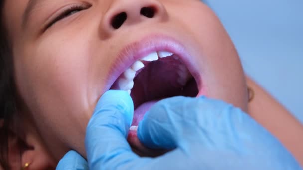 在一个有一排漂亮的婴儿牙齿的健康儿童的口腔内进行特写 小女孩张开嘴 露出上 牙齿及口腔健康检查 — 图库视频影像