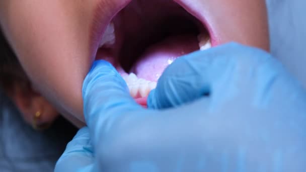 Zbliżenie Wewnątrz Jamy Ustnej Zdrowego Dziecka Pięknymi Rzędami Zębów Dziecka — Wideo stockowe