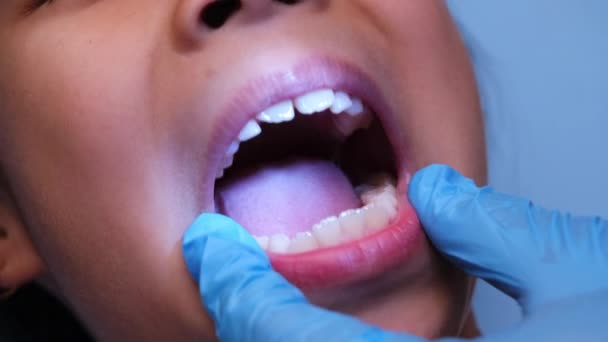 Detailní Záběr Ústní Dutiny Zdravého Dítěte Krásnými Řadami Dětských Zubů — Stock video