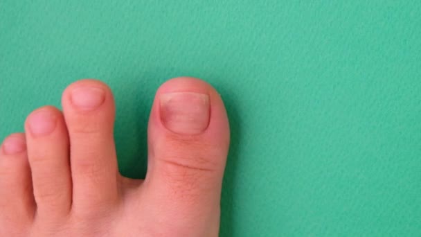 Închiderea Degetelor Picioare Deget Infecție Ciuperci Imagini Înaltă Calitate — Videoclip de stoc