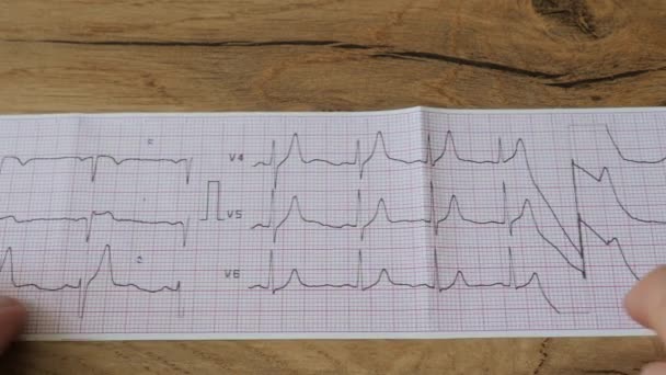 Кардиолог Анализирует Электрокардиограмму Пациента Сердечными Отклонениями Экг Экг — стоковое видео